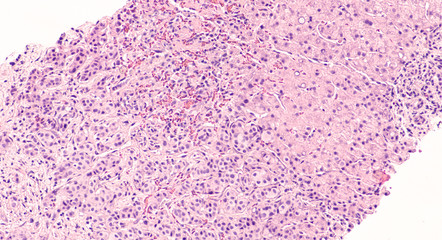 Photomicrograph of core biopsy of liver showing metastatic breast cancer (invasive ductal...