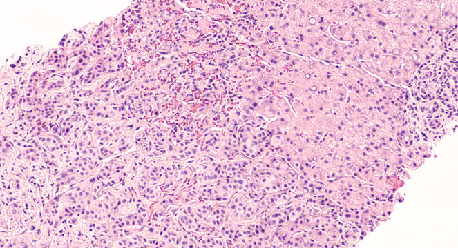 Photomicrograph of core biopsy of liver showing metastatic breast cancer (invasive ductal carcinoma).  Tumor cells seen lower left, liver tissue upper right.  