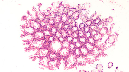 Hyperplastic colon polyps are often removed at the time of colonoscopy when screening for colon...