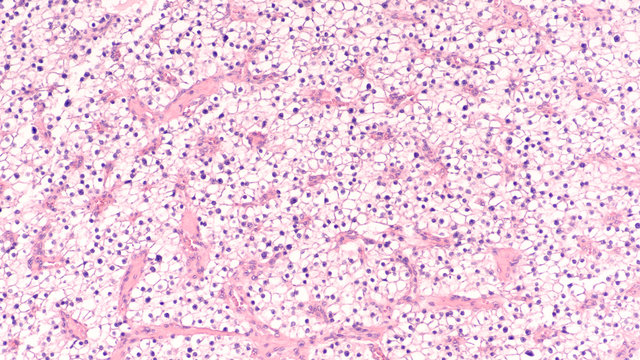 Microscopic image showing histology of a parathyroid adenoma, water clear cell type, a benign tumor that may release parathyroid hormone, resulting in abnormally high calcium levels (hypercalcemia).  