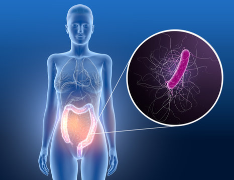 Colitis, bacterium clostridium difficile in large intestine, scientific 3D illustration