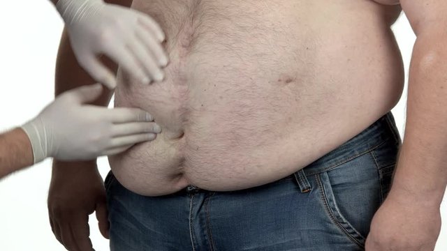 Doctor examines a belly of a fat man. Doctor in rubber gloves examining fat belly of obese man. Concept of obesity.