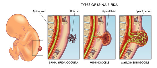 Medical illustration of infant spina bifida with annotation.