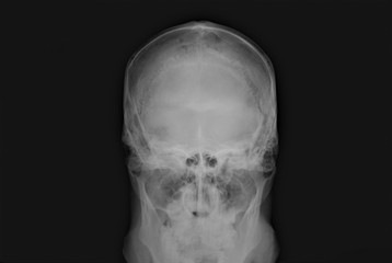 normal x-ray of the skull in direct projection, medical diagnostics, traumatology and orthopedics, neurosurgery