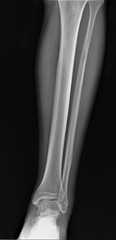 normal radiograph of the ankle joint