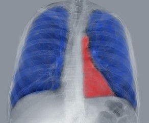 chest x-ray, red highlighted heart, blue highlighted lungs pulmonology, cardiology