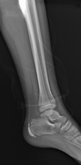 normal radiograph of the ankle joint