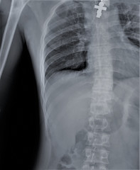 normal radiography of chest organs in direct projection, Traumatology and orthopedics, pulmonology