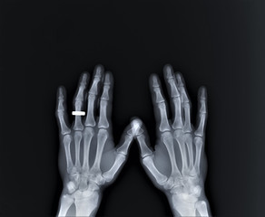 normal x-ray of the hand bones and fingers,orthopedics, medical diagnostics, rheumatology