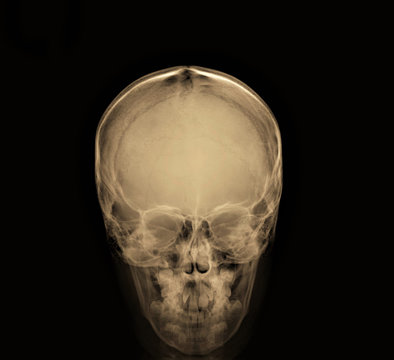 radiography of yellow skull in direct projection, medical diagnostics, Traumatology and orthopedics, neurosurgery