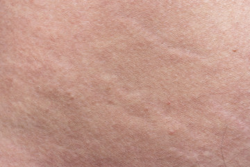 Texture of man's skin with the stretch marks, closeup photo