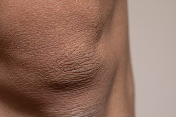 close-up of a knee of a black man with ruined skin