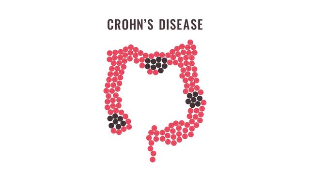 Crohn's disease awareness animation of red and black pills forming intestine. Inflammatory bowel disorder motion graphics. Medical solidarity concept. Human body organ treatment. 