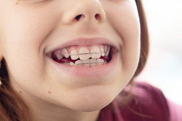 Child with removable orthodontic appliance in mouth. Concept of healthy teeth and a beautiful...