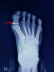 x-ray foot fracture proximal phalang and surgery fix mini plate and screws