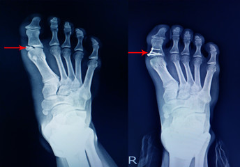 x-ray foot fracture proximal phalang and surgery fix mini plate and screws