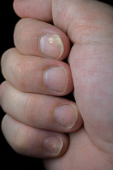 Psoriasis is an autoimmune disease that affects the nail and skin. close up of Psoriasis nail on...
