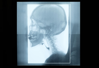 x-ray of a male head,lateral side