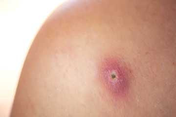 Fototapeta premium Skin of woman with big and painfull furuncle. Medicine and skincare concept