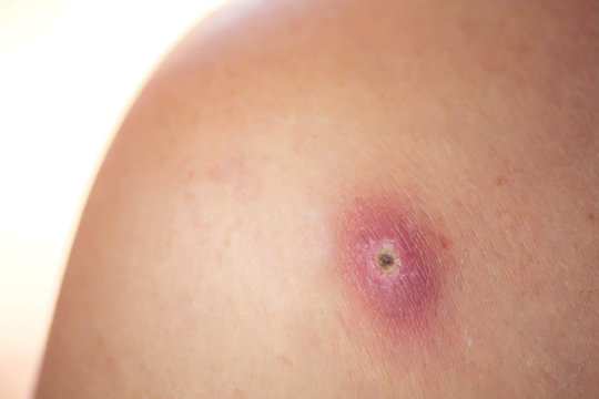 Skin of woman with big and painfull furuncle. Medicine and skincare concept