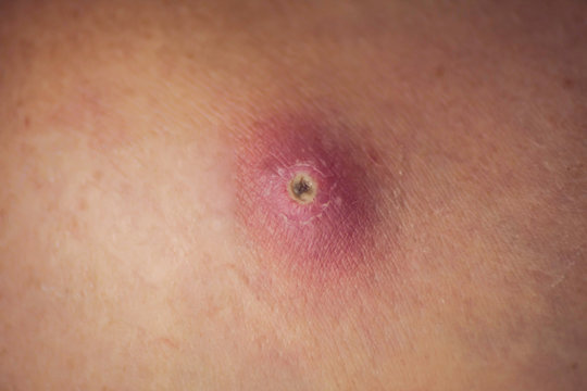 Skin of woman with big and painfull furuncle. Medicine and skincare concept