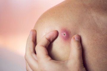 Woman tries to crush boil on her shoulder. Medicine and skin care concept