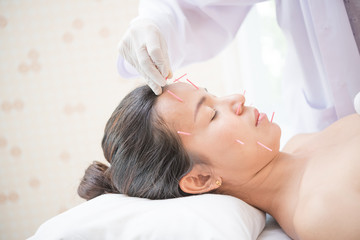 Fototapeta na wymiar Woman receiving facial acupuncture treatment