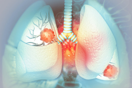 Lung cancer. lung disease. 3d illustration