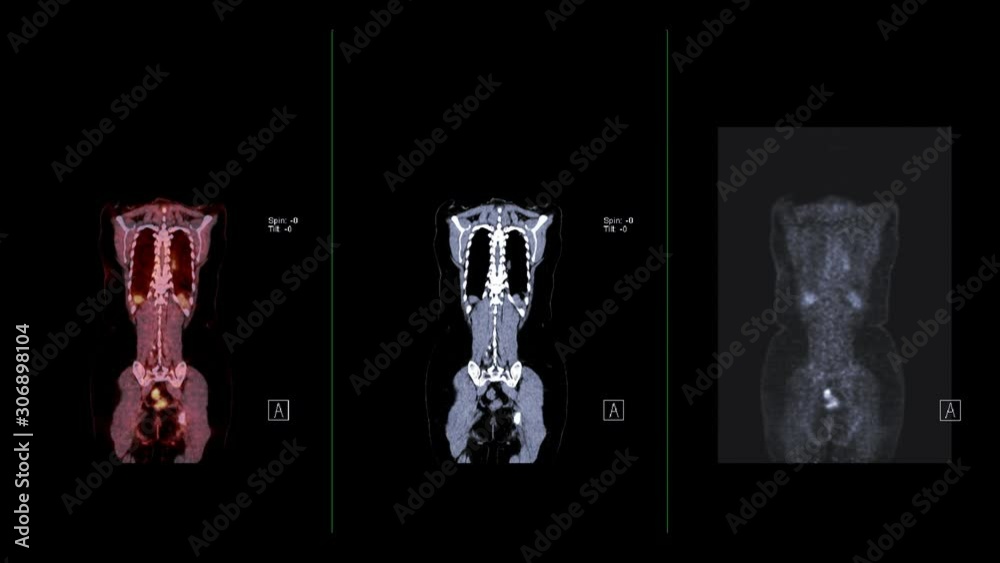 Wall mural compare ct scan image and pet ct scan fusion image of whole human body coronal plane for detect canc