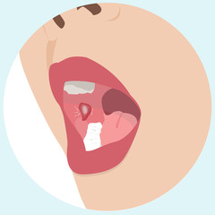 A mouth ulcer  vector illustration 