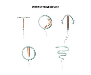 illustration of the types of intrauterine device