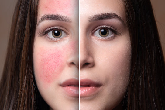 A before and after view of a beautiful young Caucasian girl suffering with rosacea. Portrait view showing results of successful laser surgery
