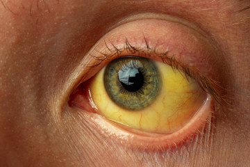 yellow staining of the sclera of the eye in diseases of the liver, cirrhosis, hepatitis, bilirubin