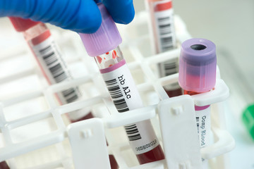 Hb A1c blood test tube chosen from rack by lab technician. The hemoglobin A1c test can asses glucose control and insulin regiment effectiveness in diabetic individuals