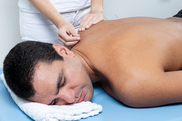 Obraz na płótnie Canvas Therapist adjusting acupuncture needles on man back in aculpulture treatment.