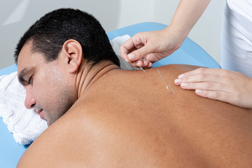 Fototapeta na wymiar Therapist adjusting acupuncture needles on man back in aculpulture treatment.