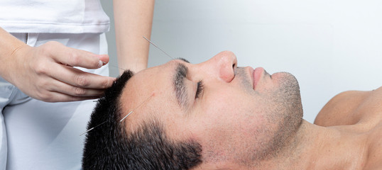 Fototapeta na wymiar Detail of therapist adjusting acupuncture needles on head of man in aculpulture treatment.