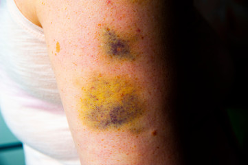 Big bruises on the arm of woman