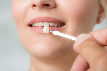 Close up of dentist using shade guide at woman's mouth to check veneer of teeth for bleaching