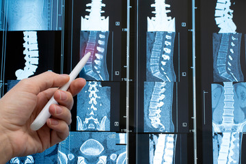 Magnetic resonance imaging (MRI) is the plane of the spine. The hand indicates a problem area.