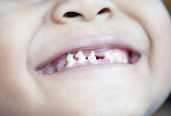 Fototapeta premium Close up image of toddler teeth with caries.Kid boy patient open mouth showing caries teeth decay for Dentist in Dental clinic.