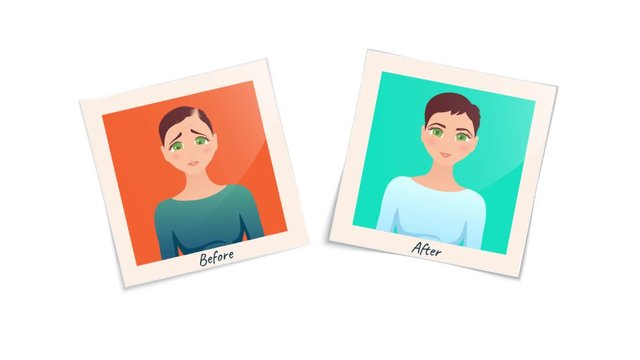 Woman before and after hair transplantation treatment. Cartoon animation of two pictures. Female hair loss motion design graphics. Alopecia medical concept. 