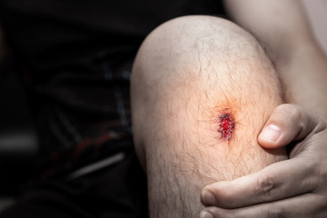Closeup of fresh wound on man's knee from accident.