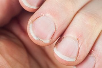 Dirty and neglected hand and damaged and overgrown nails of an adult male,