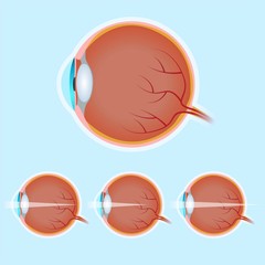 Human Eye Anatomy, Normal Eye, Myopia and Hyperopia, Visual Impairment