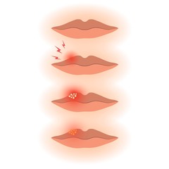 Human lips with herpes stages, treatment of viral infection