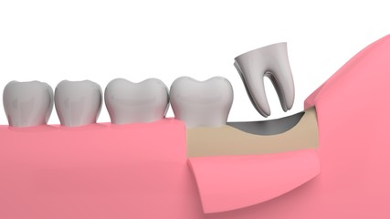Wisdom tooth removing, 3D-rendering, white background