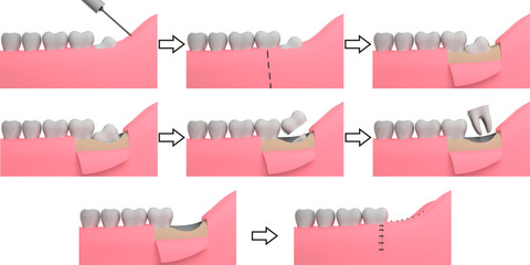 Wisdom tooth removing, collage, 3D-rendering, white background