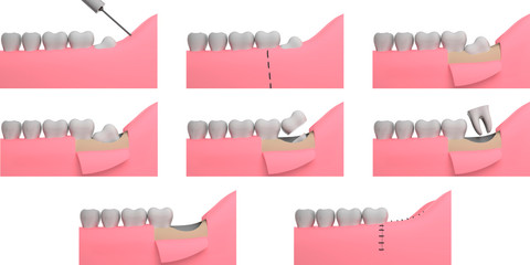 Wisdom tooth removing, collage, 3D-rendering, white background