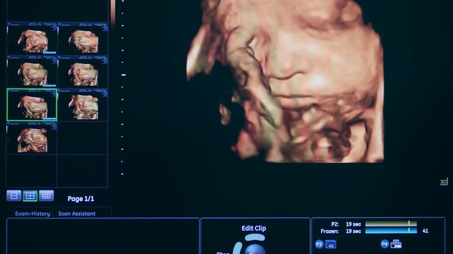 3D ultrasound image of an unborn baby